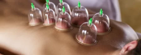 Female patient lying face down on clinic table with cupping set applied to her upper back.